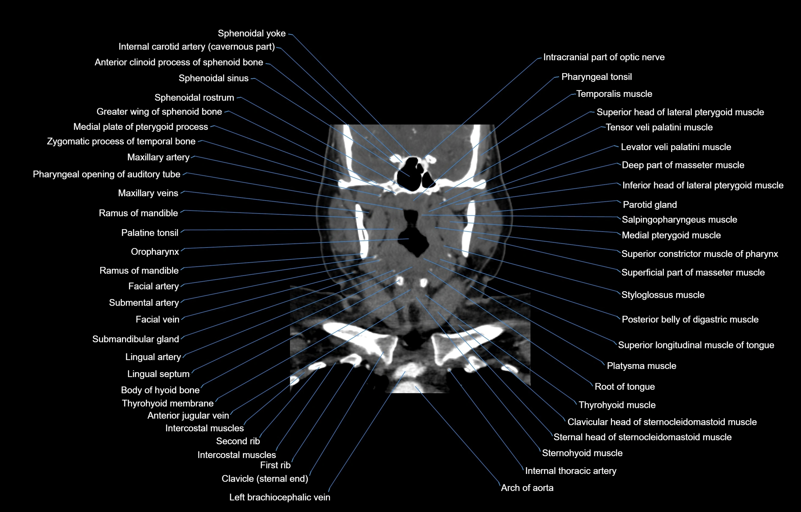 CT Neck coronal  cross sectional anatomy labelled 3D  radiology  image-00029.webp